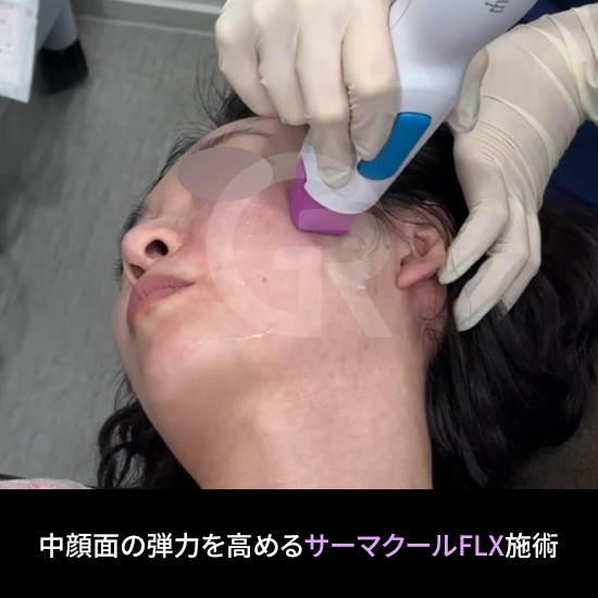 サーマクールFLXは、薄い肌に対して部位を限定して使用されます。
