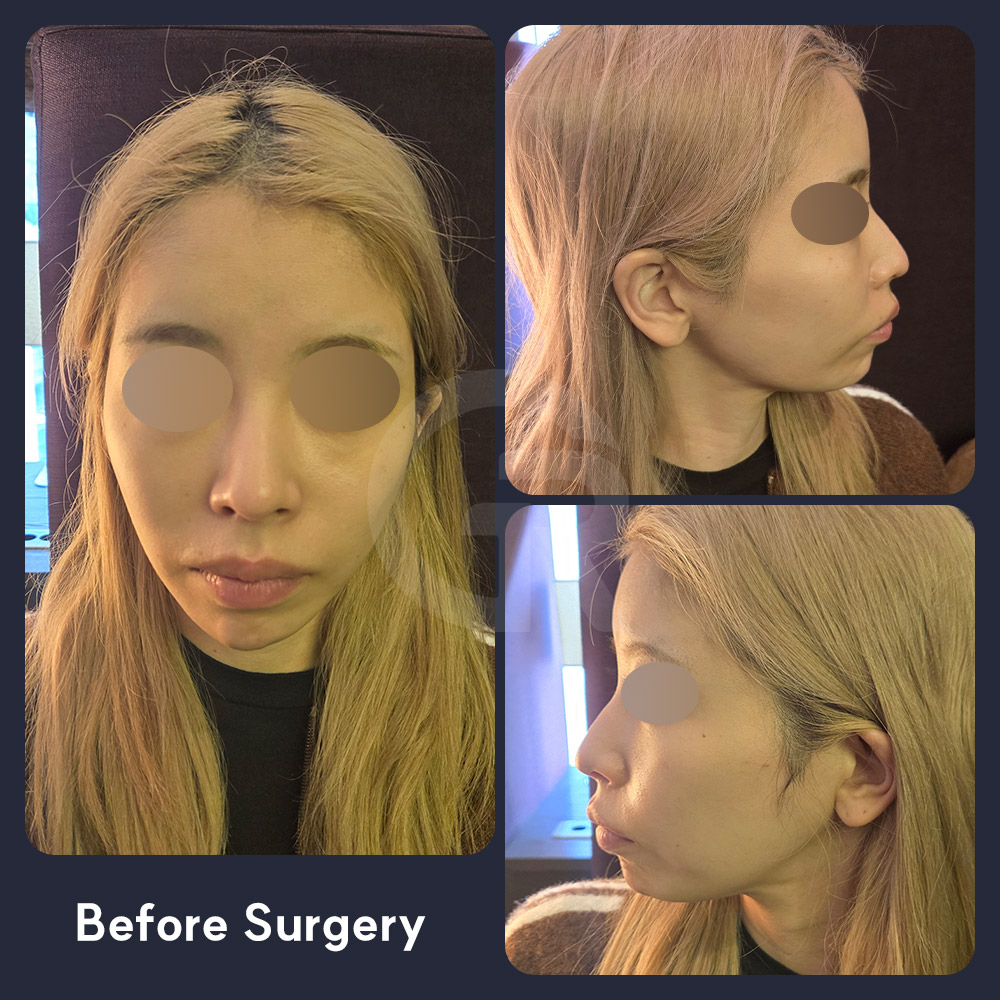 At Girin Plastic Surgery in Seoul, Korea, facial contouring surgery and fat grafting may be considered when double jaw surgery is not suitable for safety reasons.