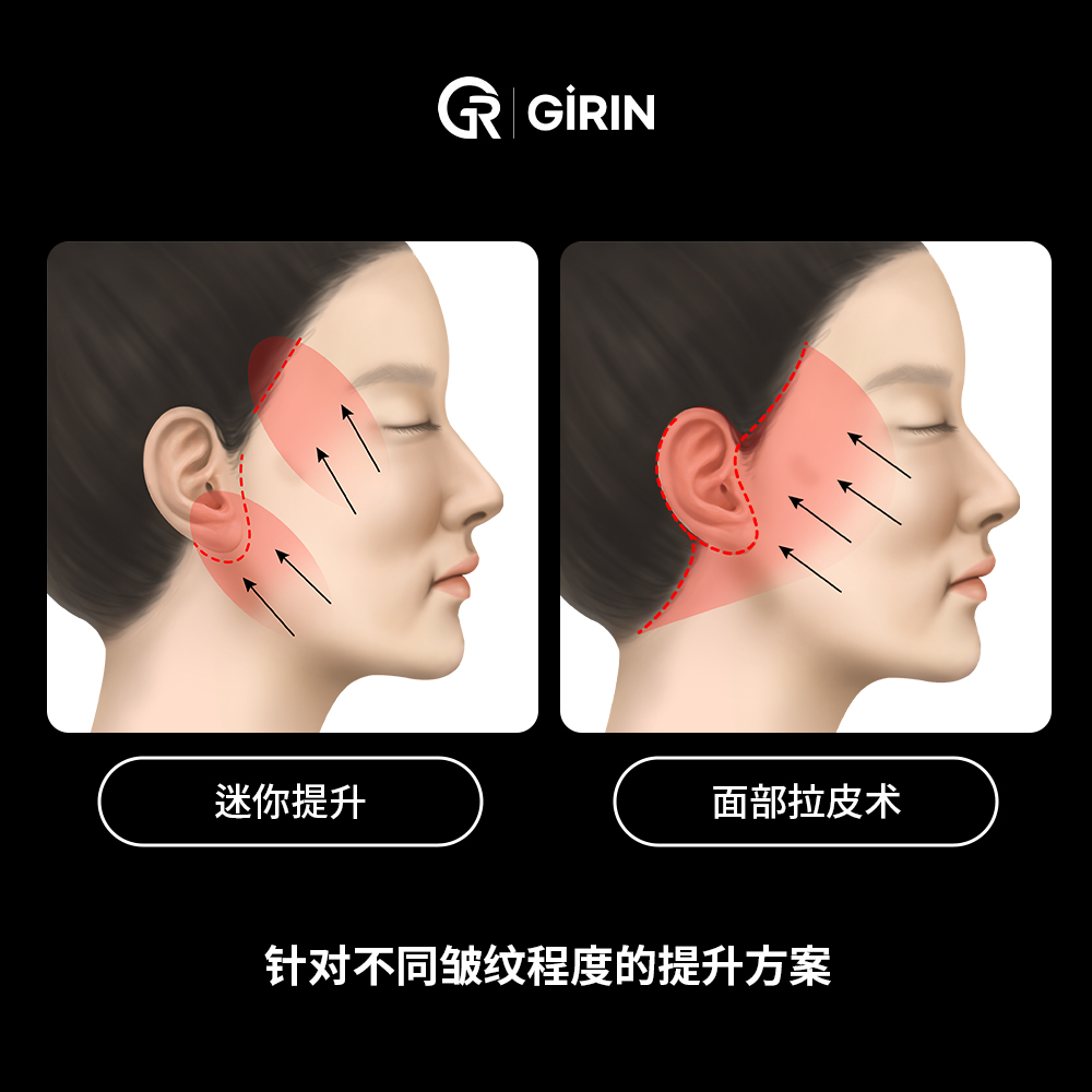 韩国常见的拉皮手术方式比较