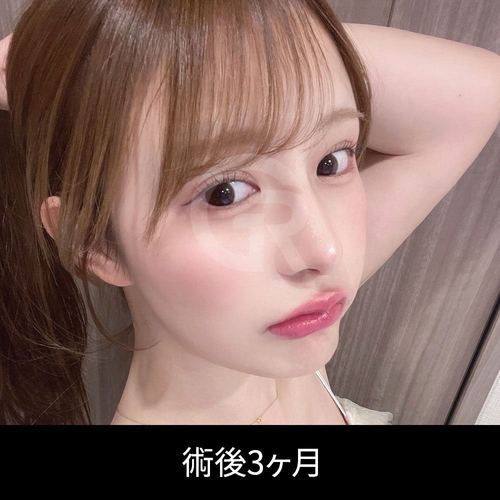 自家肋軟骨は、鼻先を安定して支える必要がある場合に選択されることがあります。