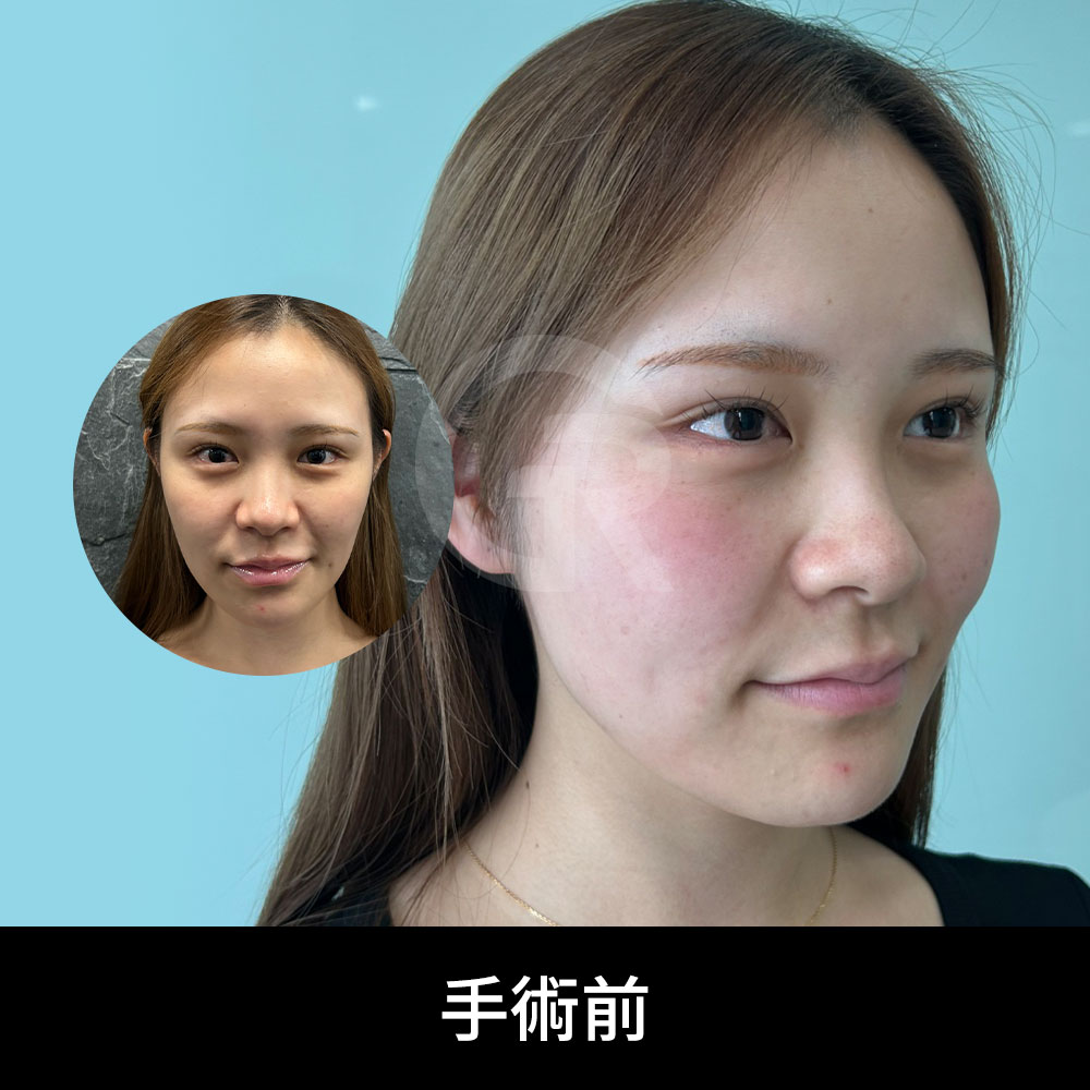 顔全体のバランスを考えた「Winter鼻」の魅力
