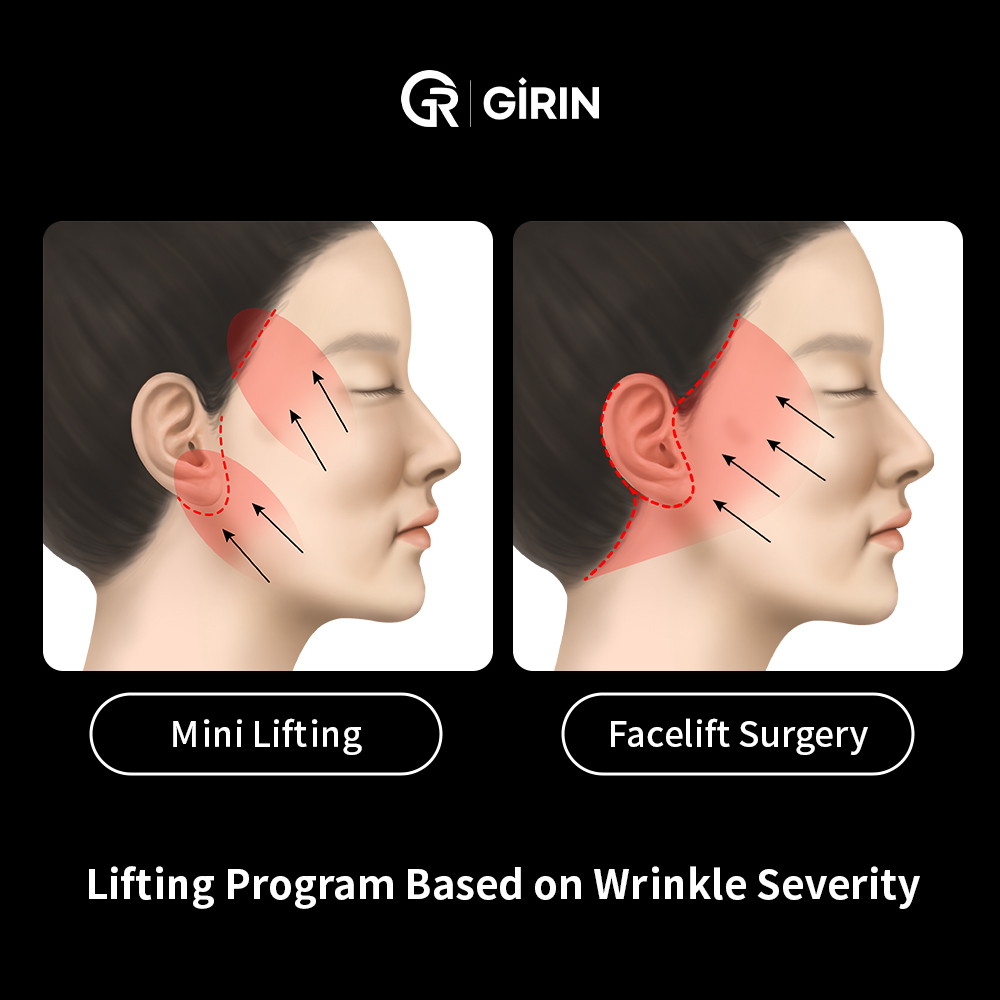 Comparison of mini facelift versus full facelift surgery in Korea
