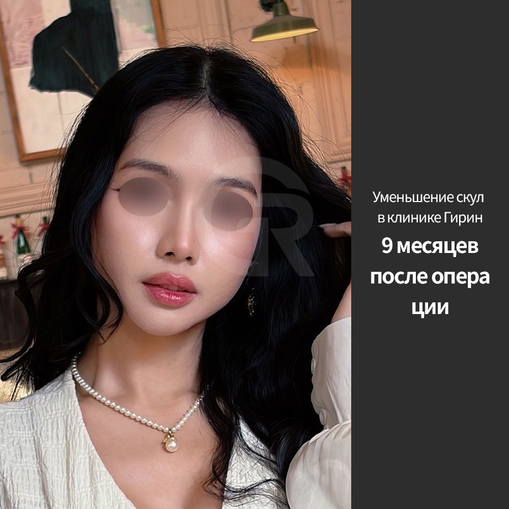 Красивый результат уменьшения скул достигается за счет коррекции угла и объема, подходящих именно этому лицу.