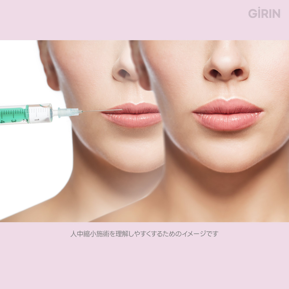 鼻下ボトックスで笑ったときの長さを改善
