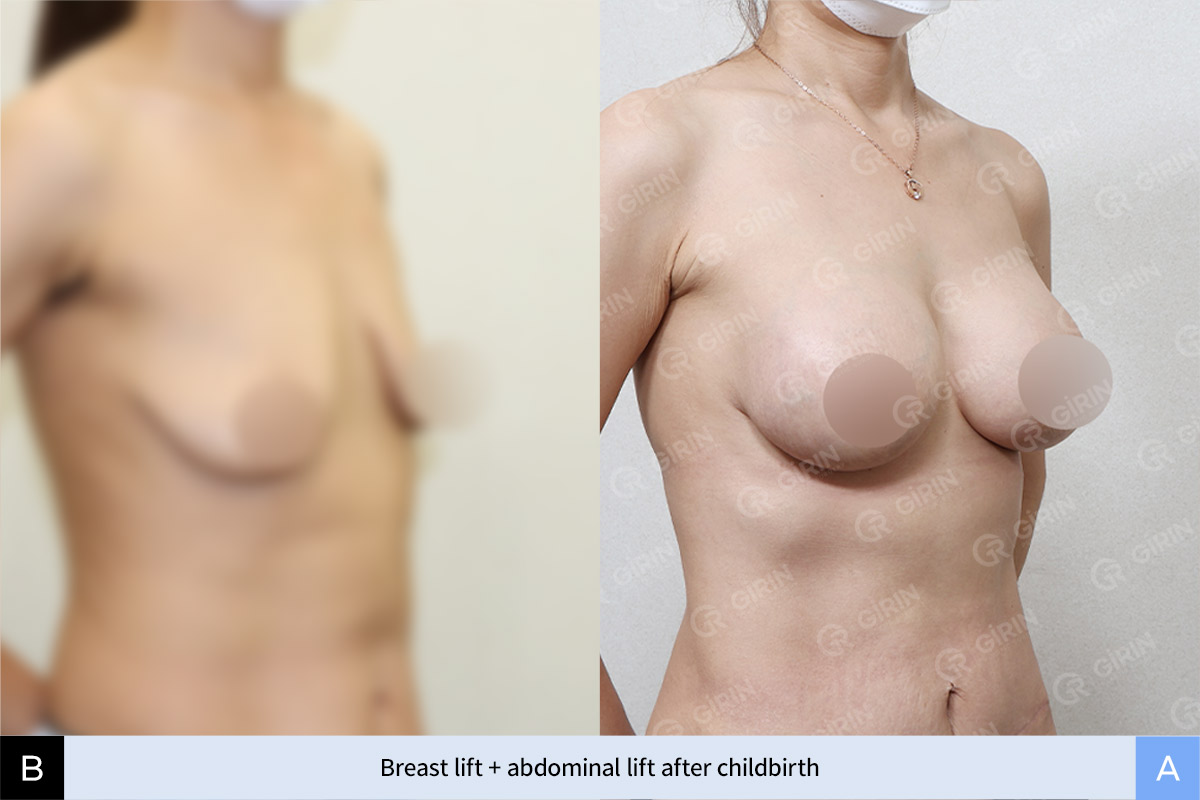 Real before-and-after breast lift case performed at Girin Plastic Surgery, Seoul.