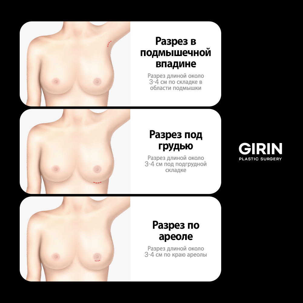 Импланты Motiva и Mentor: сравнение и особенности в контексте корейской хирургии