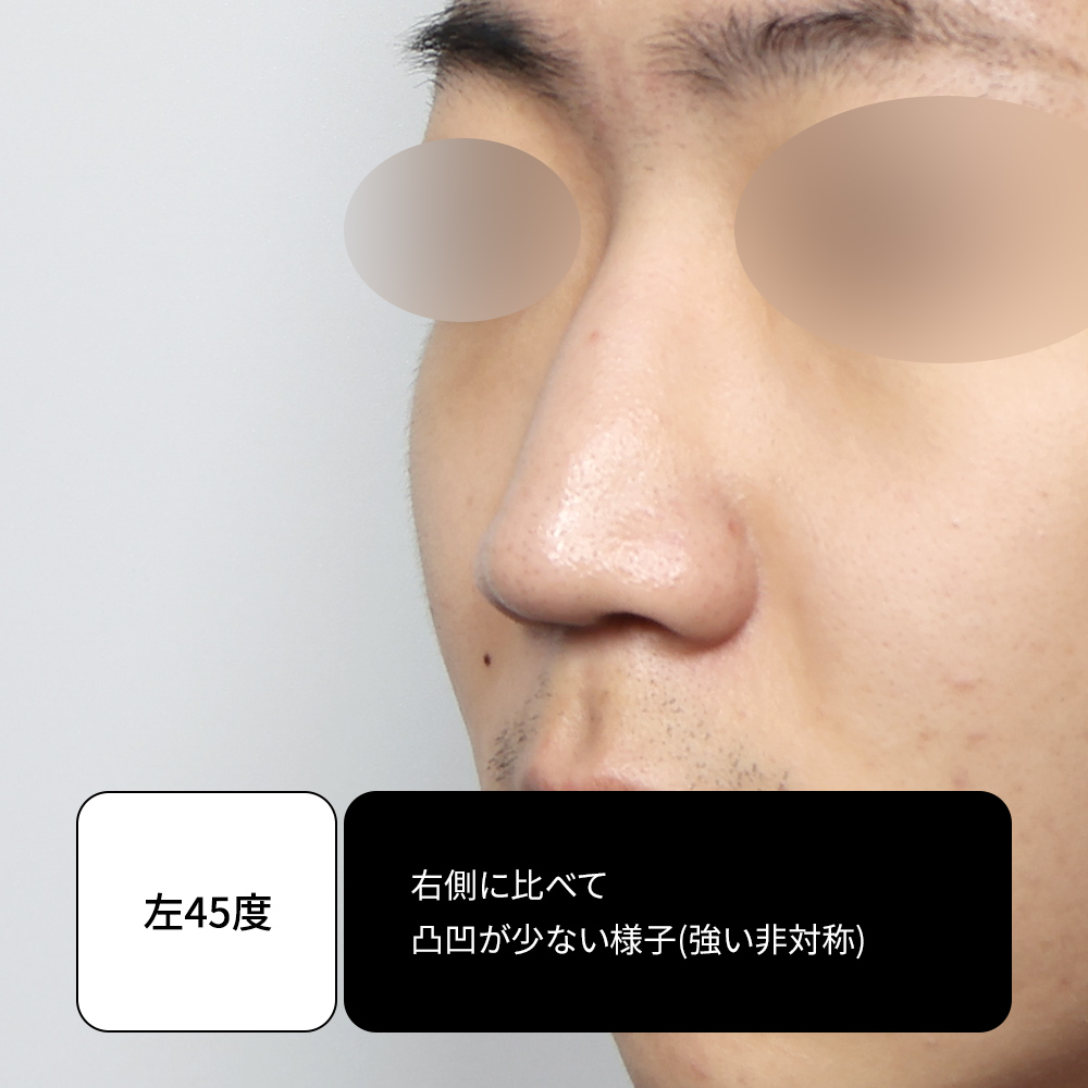 韓国の無プロテーゼ鼻整形で使用される diced cartilage 技術。