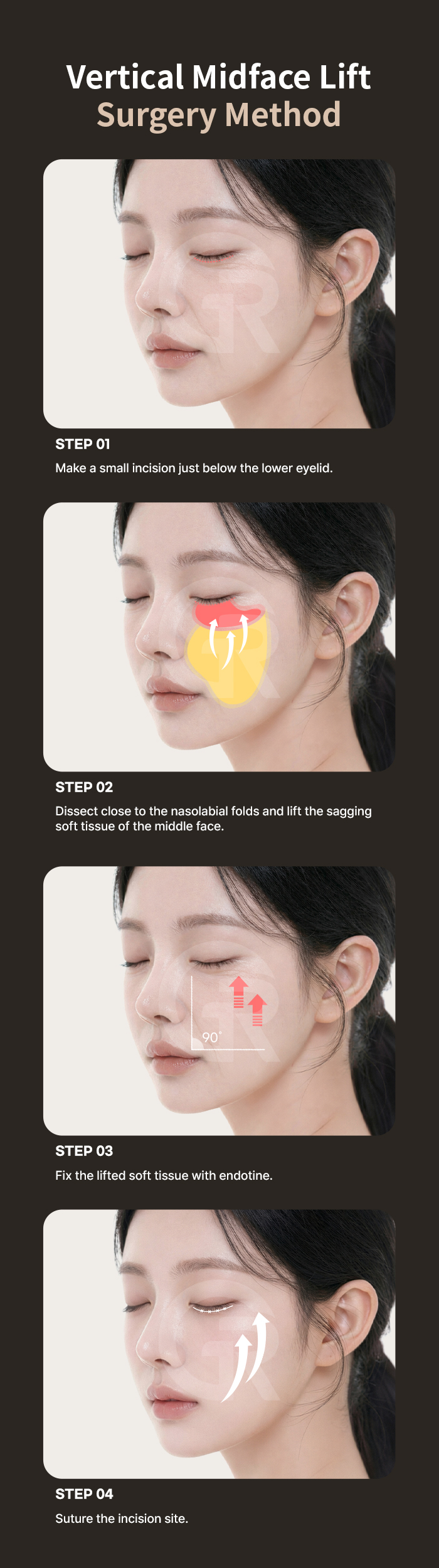 As the anterior cheek loses volume and support, the midface may shift downward as a connected unit.