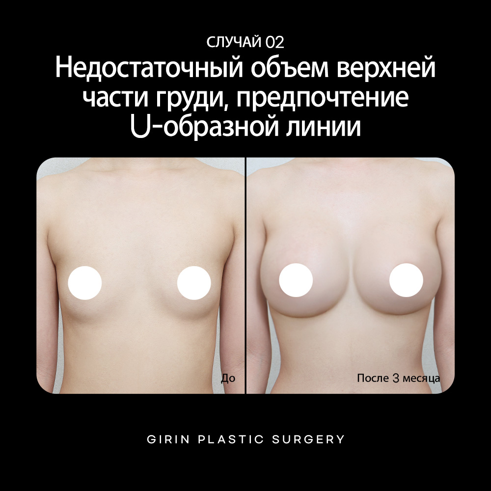 Индивидуальный подход к пластике груди в Корее – дизайн по телосложению