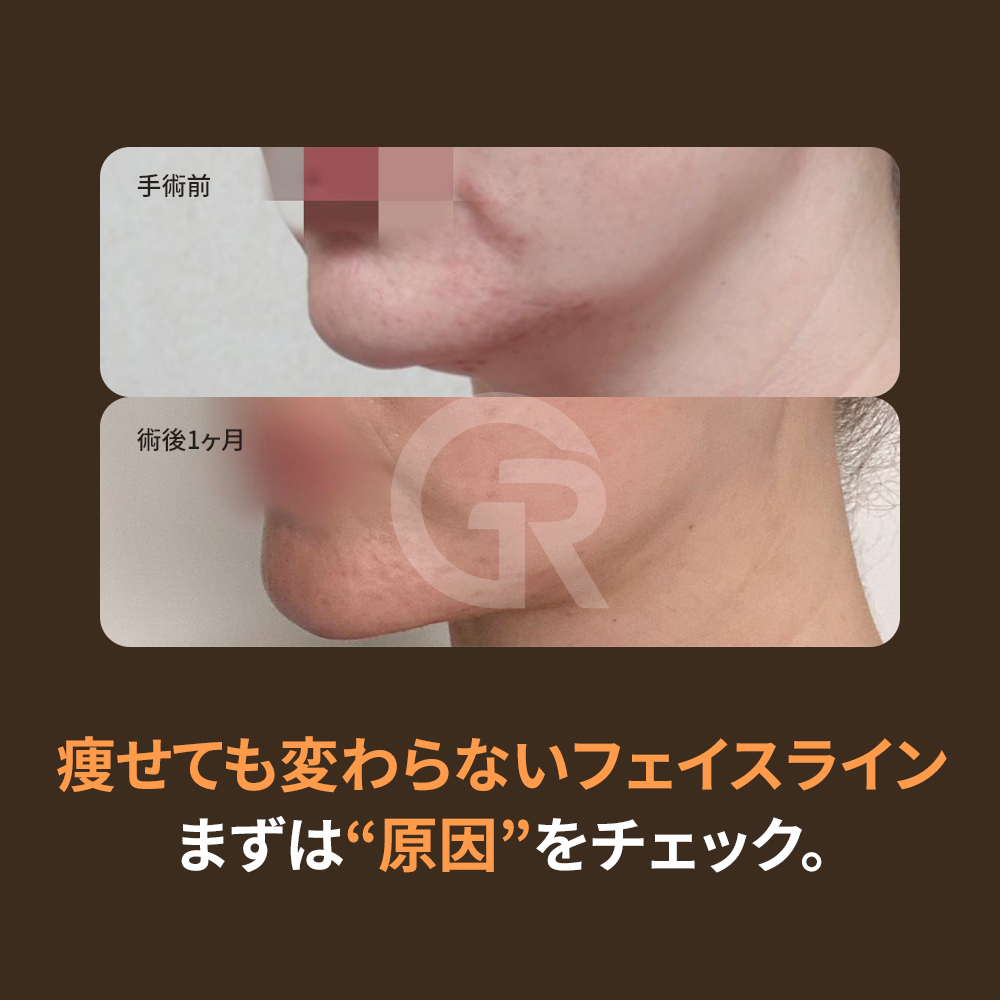 横顔であご下が重たく見える場合、あごと首の境界がどのように崩れているかを確認することが重要です。
