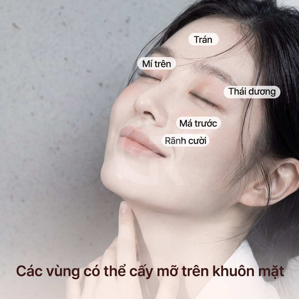 Mục tiêu của cấy mỡ vi mô là tạo nên thể tích tự nhiên và sự hài hòa cho đường nét khuôn mặt.