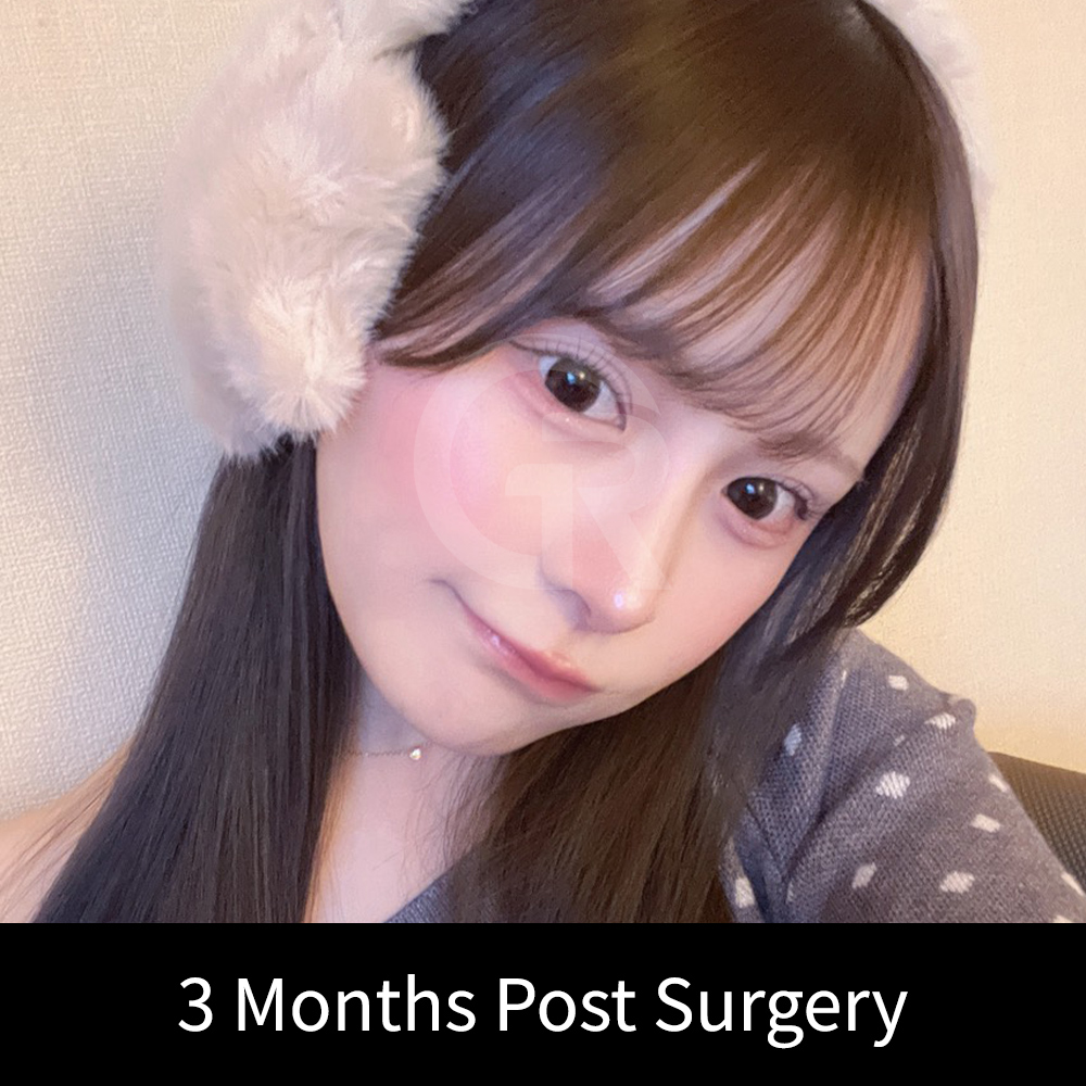 If the nasal bridge is already deviated, excessive height increase may make asymmetry appear more noticeable.