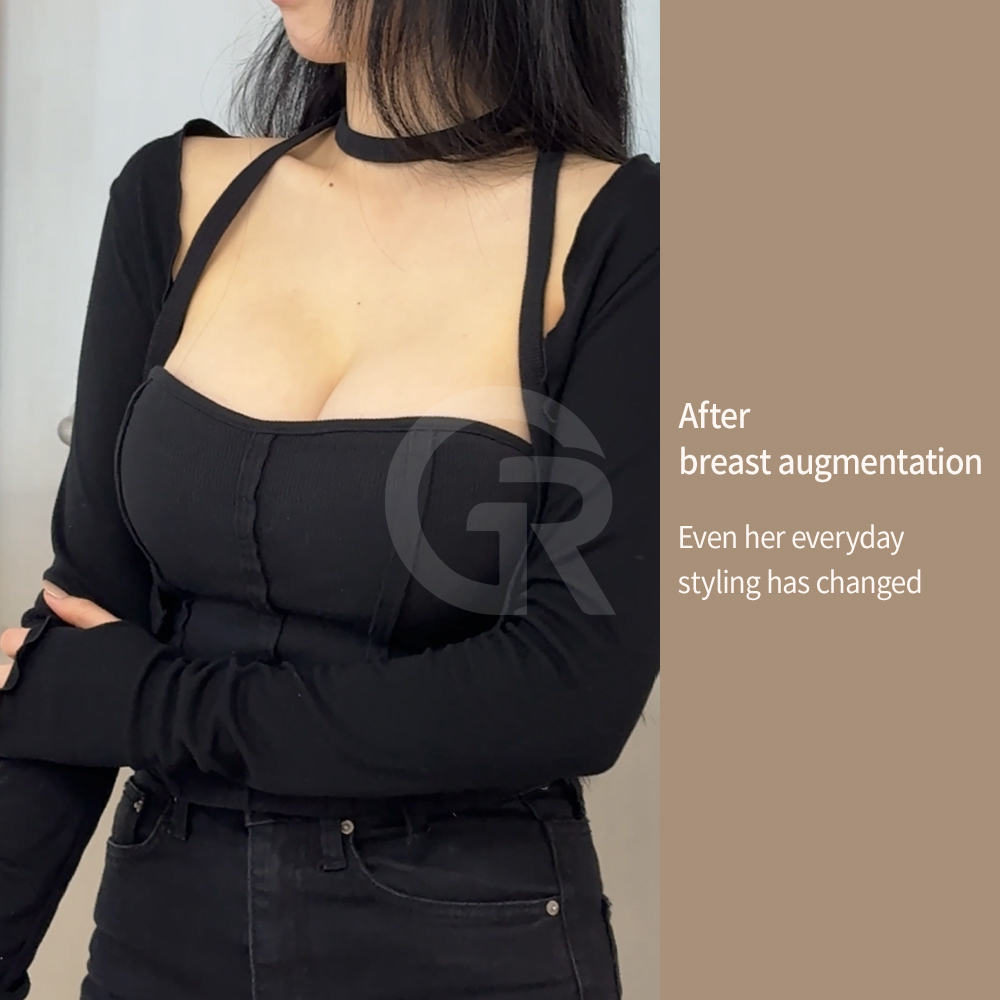 Women with athletic or slim body types often seek breast augmentation that maintains natural proportions and body balance.
