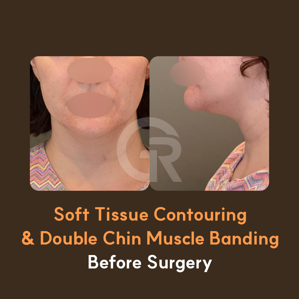 Soft tissue contouring at Girin focuses not only on reducing fat, but also on reorganizing the line under the chin.