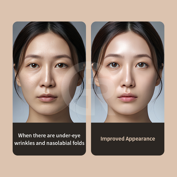 Deepening of nasolabial folds may reflect structural cheek descent rather than isolated fold formation.