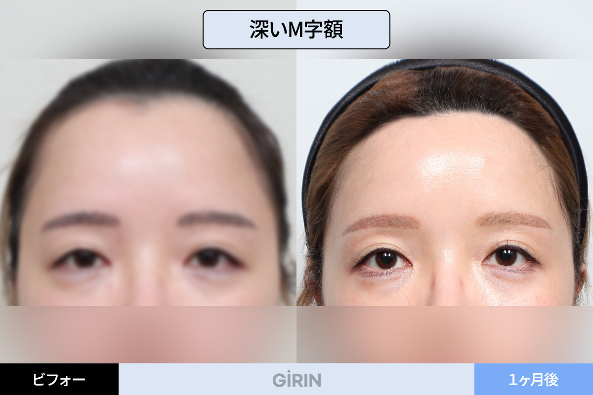 ヘアライン下降術の流れと施術ステップを分かりやすく解説。