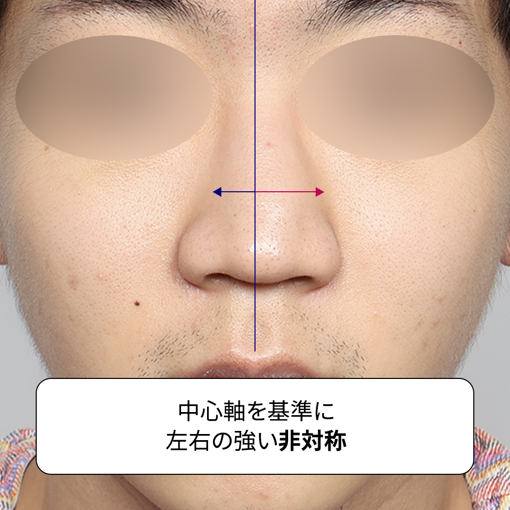 韓国で有名な鼻整形クリニック GIRIN PLASTIC SURGERY の男性ジェリーコ鼻整形症例。