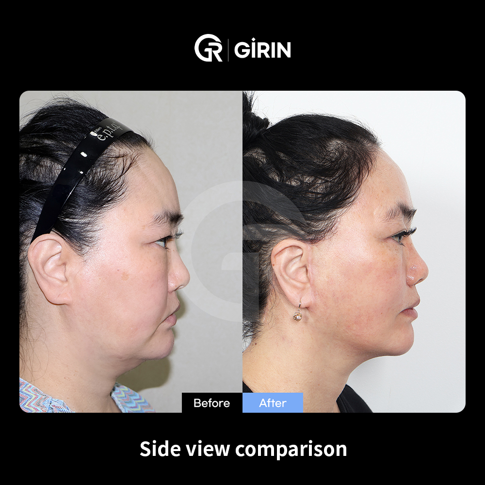 Price differences between mini facelift and full facelift procedures in Korea