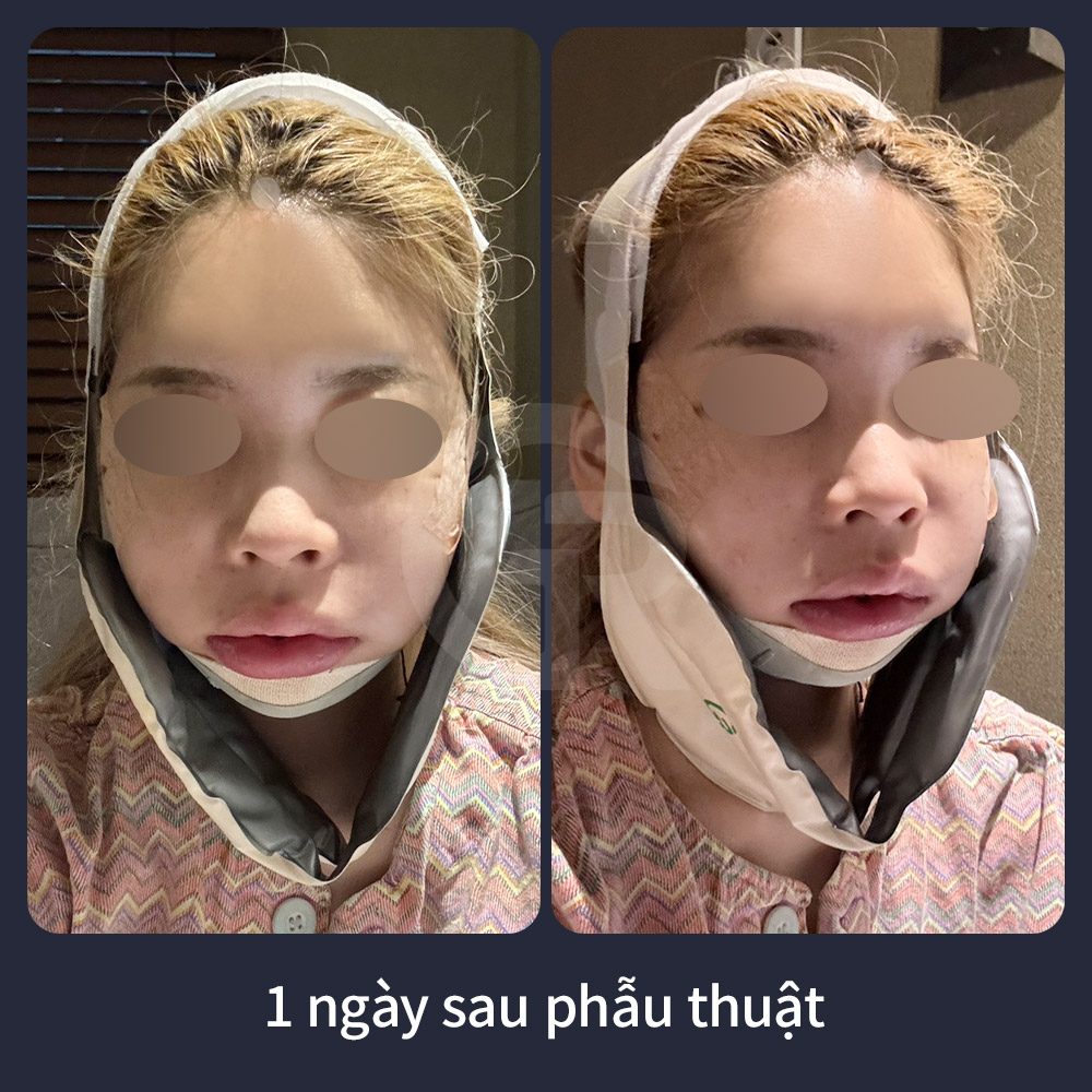Khi khoảng không đường thở hẹp, Girin Plastic Surgery tại Seoul đánh giá kỹ yếu tố an toàn trước khi lập kế hoạch di chuyển xương hàm.