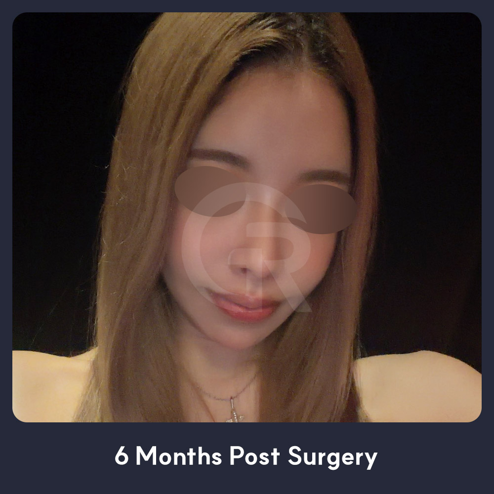 Cheekbone reduction can refine protruding areas while preserving the three-dimensional balance of the midface.