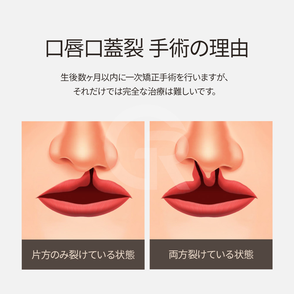 鼻孔非対称を改善する韓国ソウルの鼻整形症例。