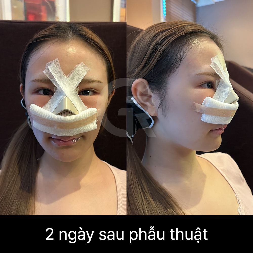 Đường mũi thẳng hơi cong mềm mại có thể tạo cảm giác nữ tính khi được điều chỉnh phù hợp với tổng thể khuôn mặt.