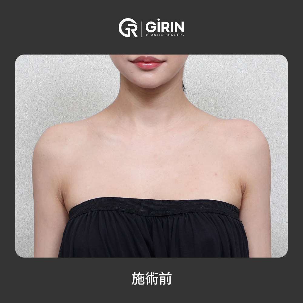 肩の傾斜を整えるフィラー注入例