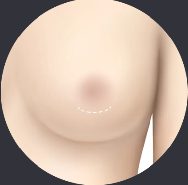 乳晕切口