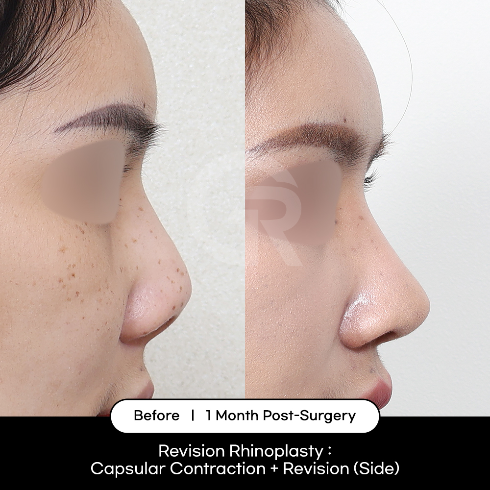 Revision rhinoplasty in Korea correcting structural issues and imbalance after previous nose surgery