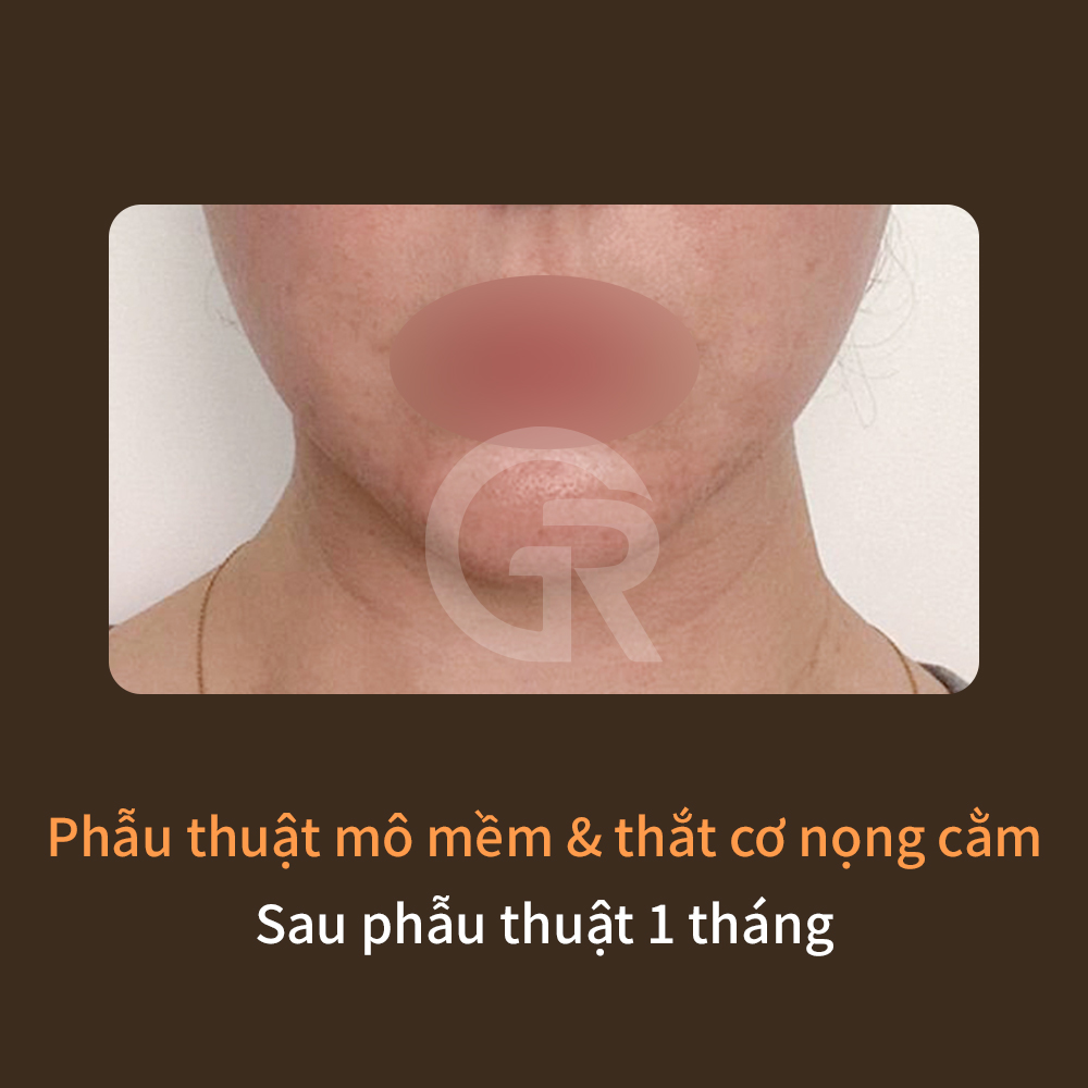 Cùng là vấn đề nọng cằm, nhưng nguyên nhân có thể khác nhau như mỡ, da chảy xệ, cơ lỏng lẻo hoặc thói quen tư thế.