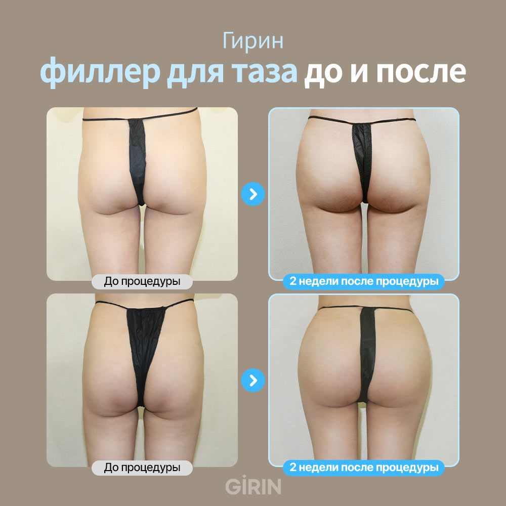 Что такое hip dips: нормальная анатомическая особенность боковой линии бедра — пояснительная схема