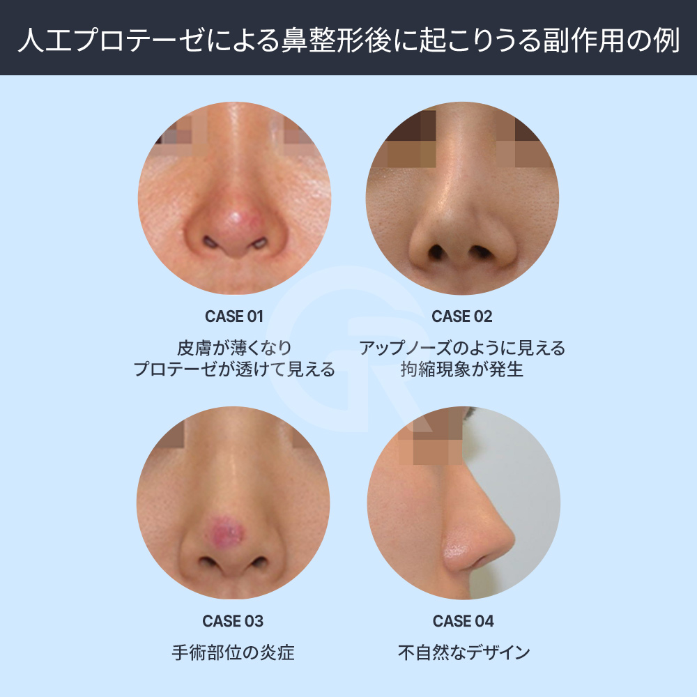プロテーゼを使わない鼻整形では、顔全体と調和する自然な鼻のラインを重視します。
