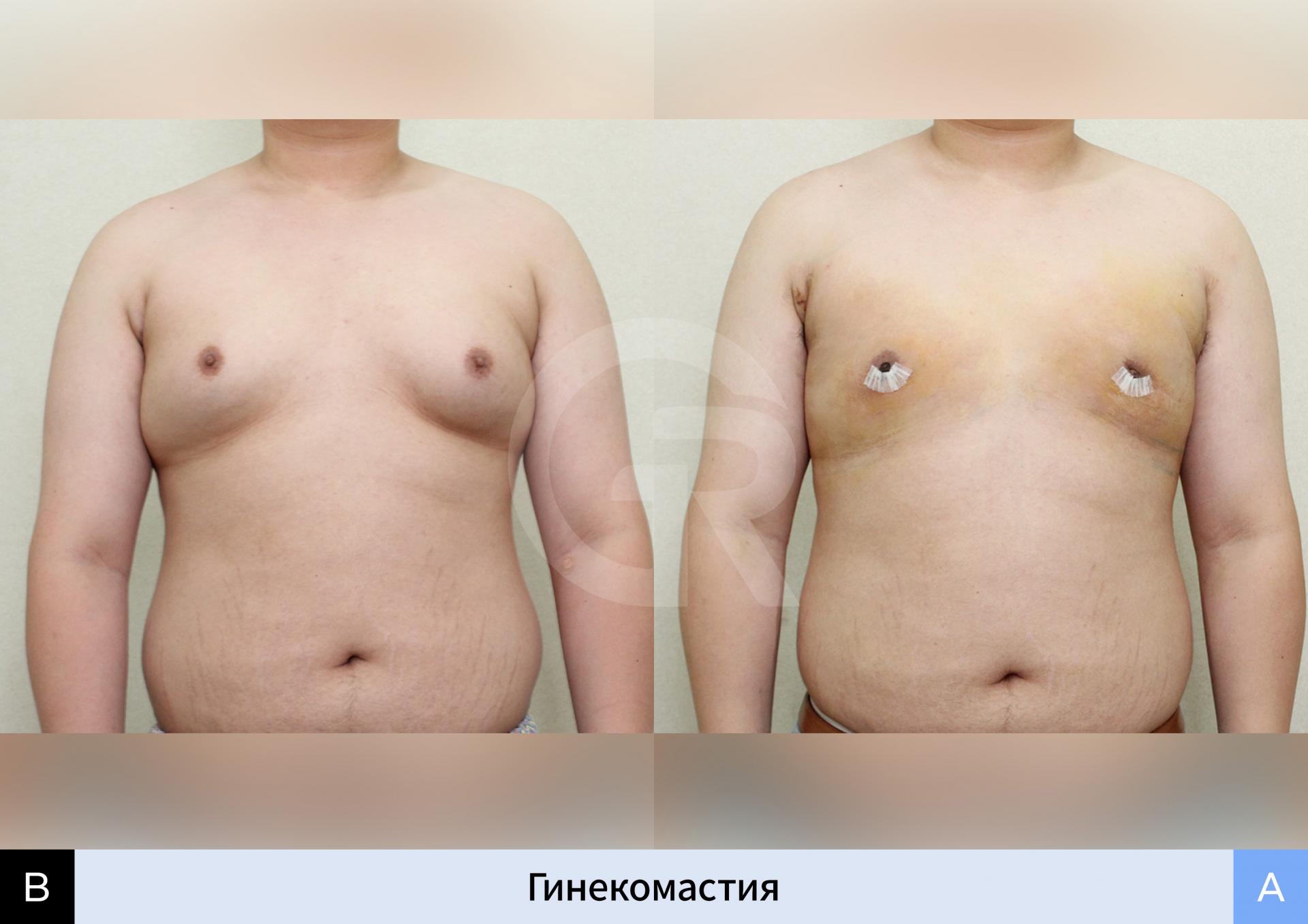 Пациент с худощавым телосложением и истинной гинекомастией