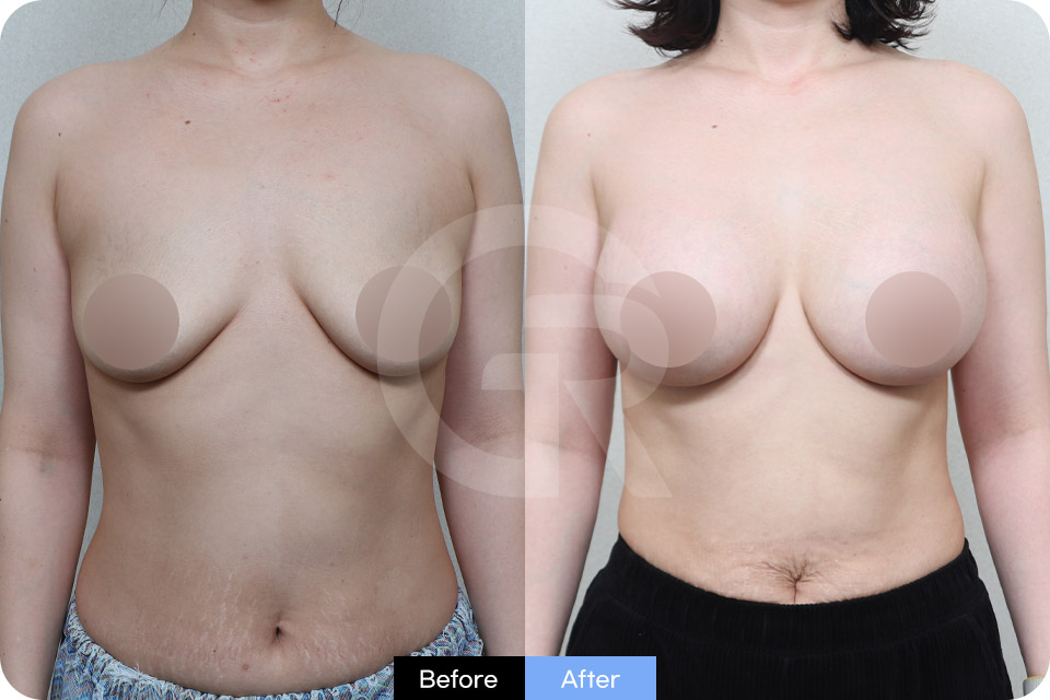 Girin Plastic Surgery Korea Breast Augmentation case 07 Front