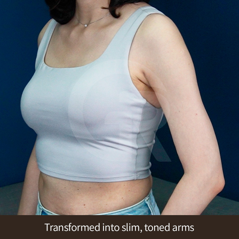 Bio-bonding refers to temporary firmness caused by tissue healing during recovery.