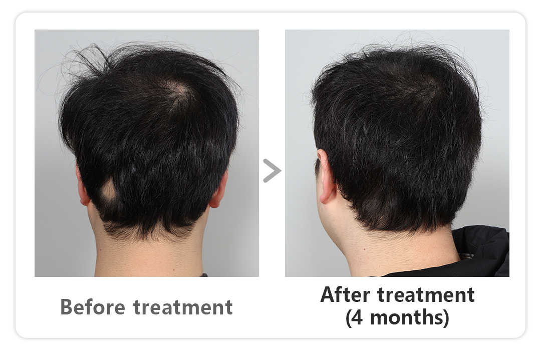 best hair loss treatment in korea
