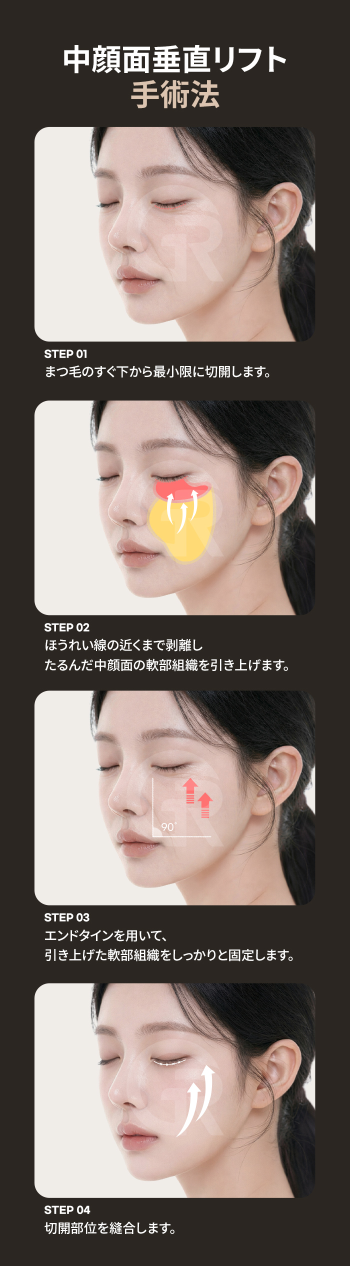 중안부가 내려가면 얼굴이 세로로 길어 보이기 쉽습니다.