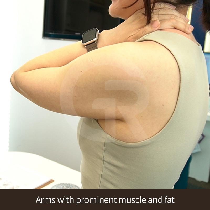 Many patients feel stressed about thick-looking upper arms despite maintaining a healthy lifestyle.