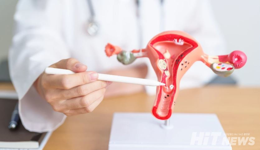 난소 모형을 가리키는 의사