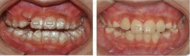 울산 치아교정 추천