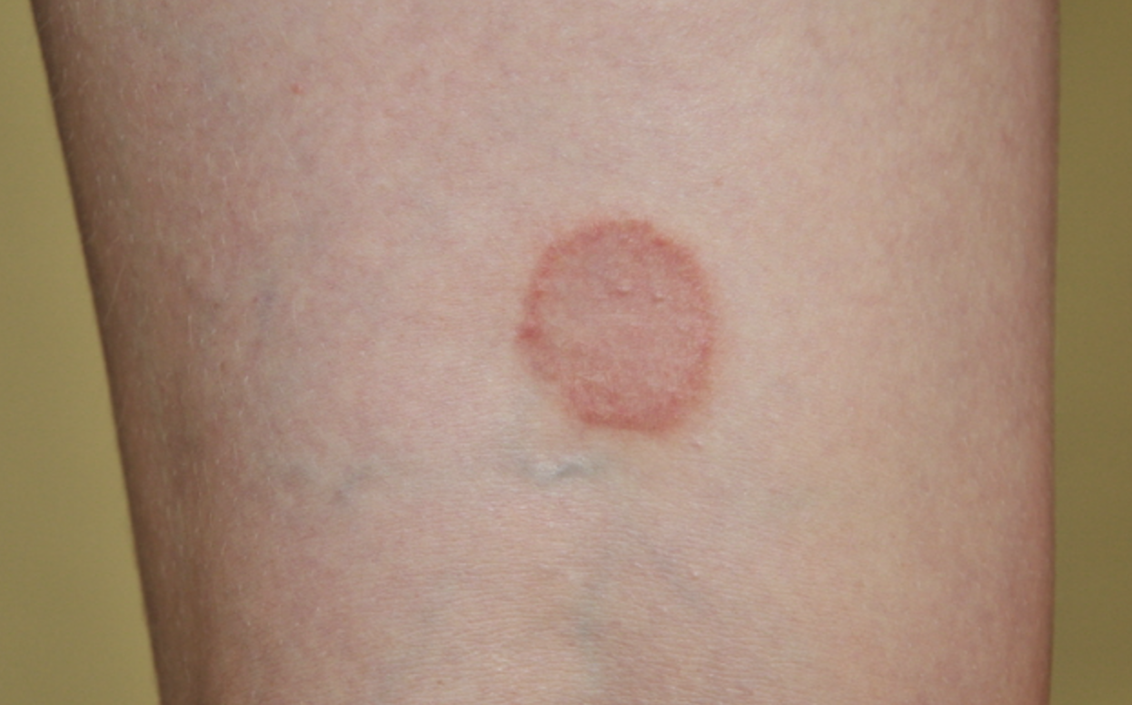 3. 상식노트 질병링웜 고양이 무좀 note