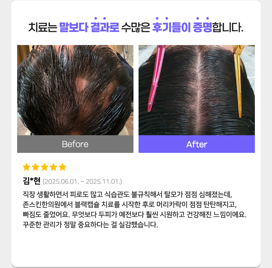 치료는 말보다 결과로 수많은 후기들이 증명합니다. 별점 5개
김*현(2025.06.01. ~ 2025.11.01.)
직장 생활하면서 피로도 많고 식습관도 불규칙해서 탈모가 점점 심해졌는데, 존스킨한의원에서 블랙캡슐 치료를 시작한 후로 머리카락이 점점 탄탄해지고, 빠짐도 줄었어요. 
무엇보다 두피가 예전보다 훨씬 시원하고 건강해진 느낌이에요. 꾸준한 관리가 정말 중요하다는 걸 실감했습니다.