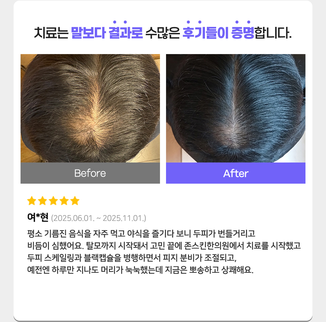 치료는 말보다 결과로 수많은 후기들이 증명합니다. 별점 5개
여*현(2025.06.01. ~ 2025.11.01.)
평소 기름진 음식을 자주 먹고 야식을 즐기다 보니 두피가 번들거리고 비듬이 심했어요. 
탈모까지 시작돼서 고민 끝에 존스킨한의원에서 치료를 시작했고두피 스케일링과 블랙캡슐을 병행하면서 피지 분비가 조절되고, 예전엔 하루만 지나도 머리가 눅눅했는데 지금은 뽀송하고 상쾌해요. 