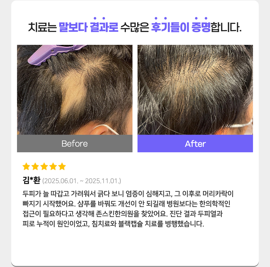 치료는 말보다 결과로 수많은 후기들이 증명합니다. 별점 5개
김*환(2025.06.01. ~ 2025.11.01.)
두피가 늘 따갑고 가려워서 긁다 보니 염증이 심해지고, 그 이후로 머리카락이 빠지기 시작했어요. 
샴푸를 바꿔도 개선이 안 되길래 병원보다는 한의학적인접근이 필요하다고 생각해 존스킨한의원을 찾았어요. 
진단 결과 두피열과피로 누적이 원인이었고, 침치료와 블랙캡슐 치료를 병행했습니다.