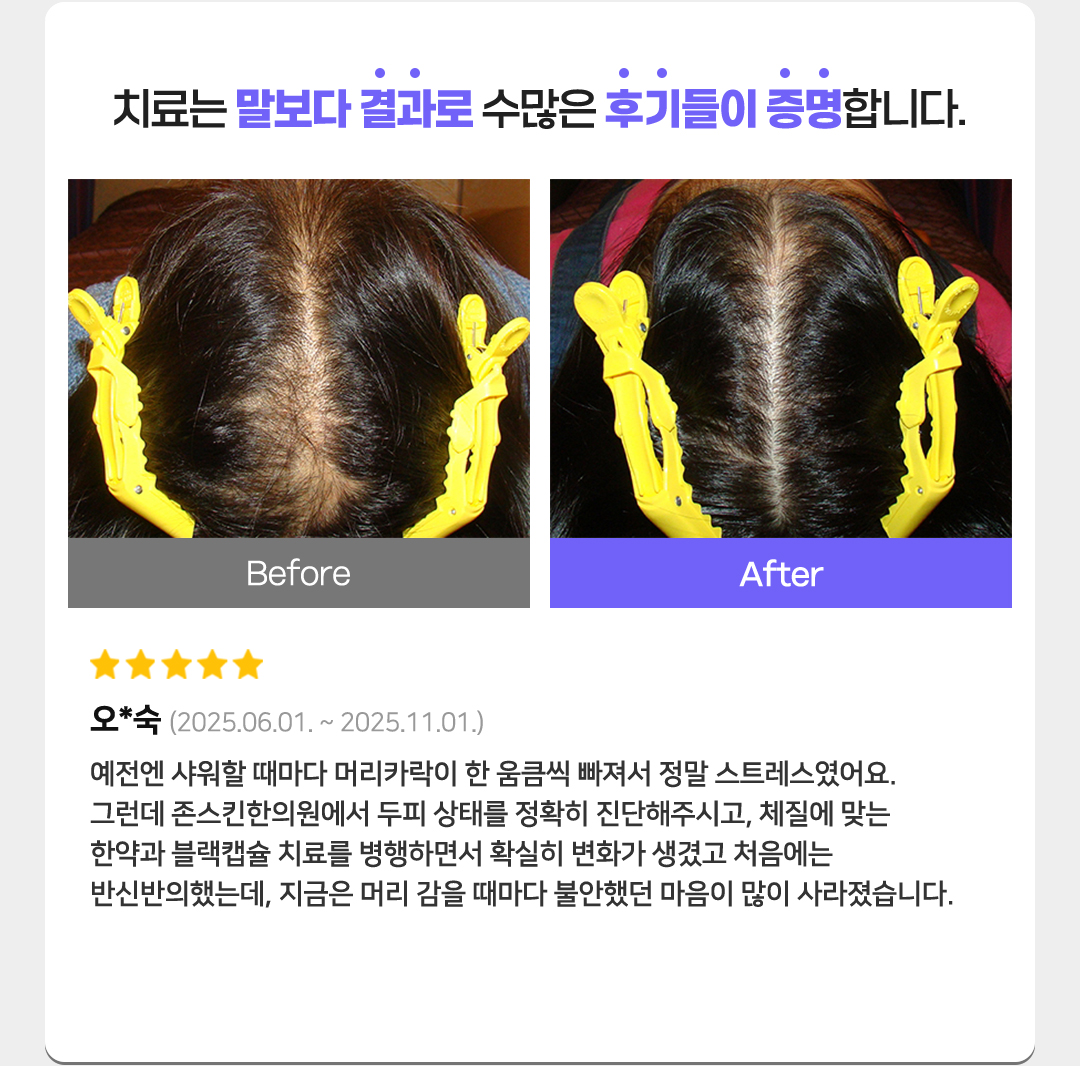 치료는 말보다 결과로 수많은 후기들이 증명합니다. 별점 5개
오*숙(2025.06.01. ~ 2025.11.01.)
예전엔 샤워할 때마다 머리카락이 한 움큼씩 빠져서 정말 스트레스였어요.
그런데 존스킨한의원에서 두피 상태를 정확히 진단해주시고, 체질에 맞는한약과 블랙캡슐 치료를 병행하면서 확실히 변화가 생겼고 처음에는반신반의했는데, 지금은 머리 감을 때마다 불안했던 마음이 많이 사라졌습니다