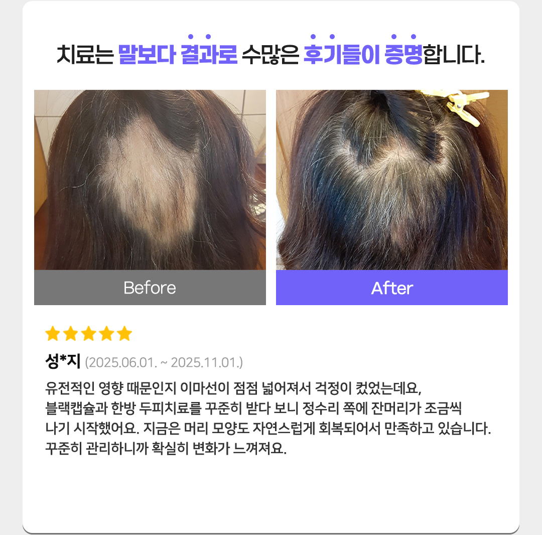 치료는 말보다 결과로 수많은 후기들이 증명합니다. 별점 5개
성*지(2025.06.01. ~ 2025.11.01.)
유전적인 영향 때문인지 이마선이 점점 넓어져서 걱정이 컸었는데요,
블랙캡슐과 한방 두피치료를 꾸준히 받다 보니 정수리 쪽에 잔머리가 조금씩 나기 시작했어요. 
지금은 머리 모양도 자연스럽게 회복되어서 만족하고 있습니다.
꾸준히 관리하니까 확실히 변화가 느껴져요.