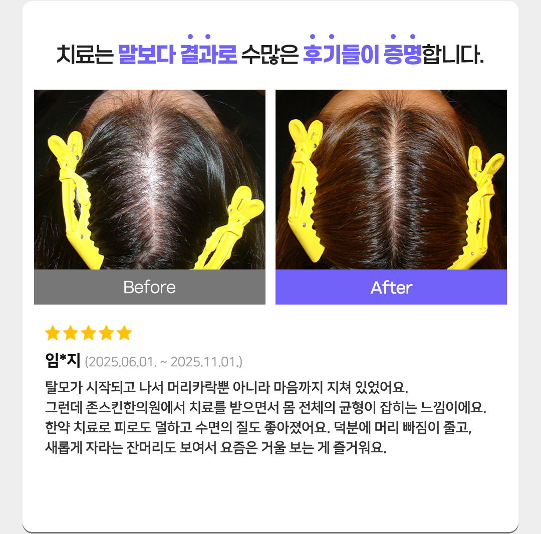 치료는 말보다 결과로 수많은 후기들이 증명합니다. 별점 5개
임*지(2025.06.01. ~ 2025.11.01.)
탈모가 시작되고 나서 머리카락뿐 아니라 마음까지 지쳐 있었어요.
그런데 존스킨한의원에서 치료를 받으면서 몸 전체의 균형이 잡히는 느낌이에요.
한약 치료로 피로도 덜하고 수면의 질도 좋아졌어요. 
덕분에 머리 빠짐이 줄고, 새롭게 자라는 잔머리도 보여서 요즘은 거울 보는 게 즐거워요.