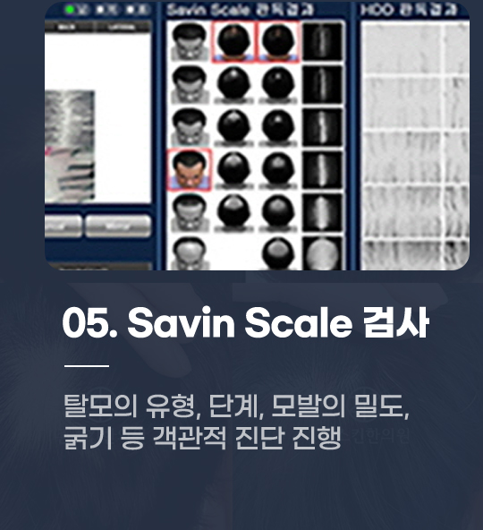 05. Savin Scale 검사 탈모의 유형, 단계, 모발의 밀도, 굵기 등 객관적 진단 진행