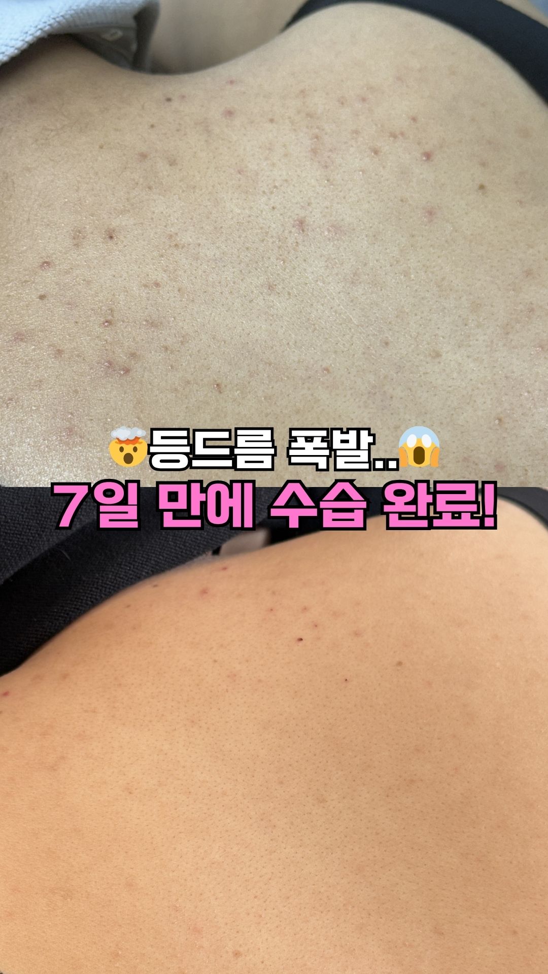 왁싱 후관리 풀케어 세트 (미스트5 + 스크럽5)