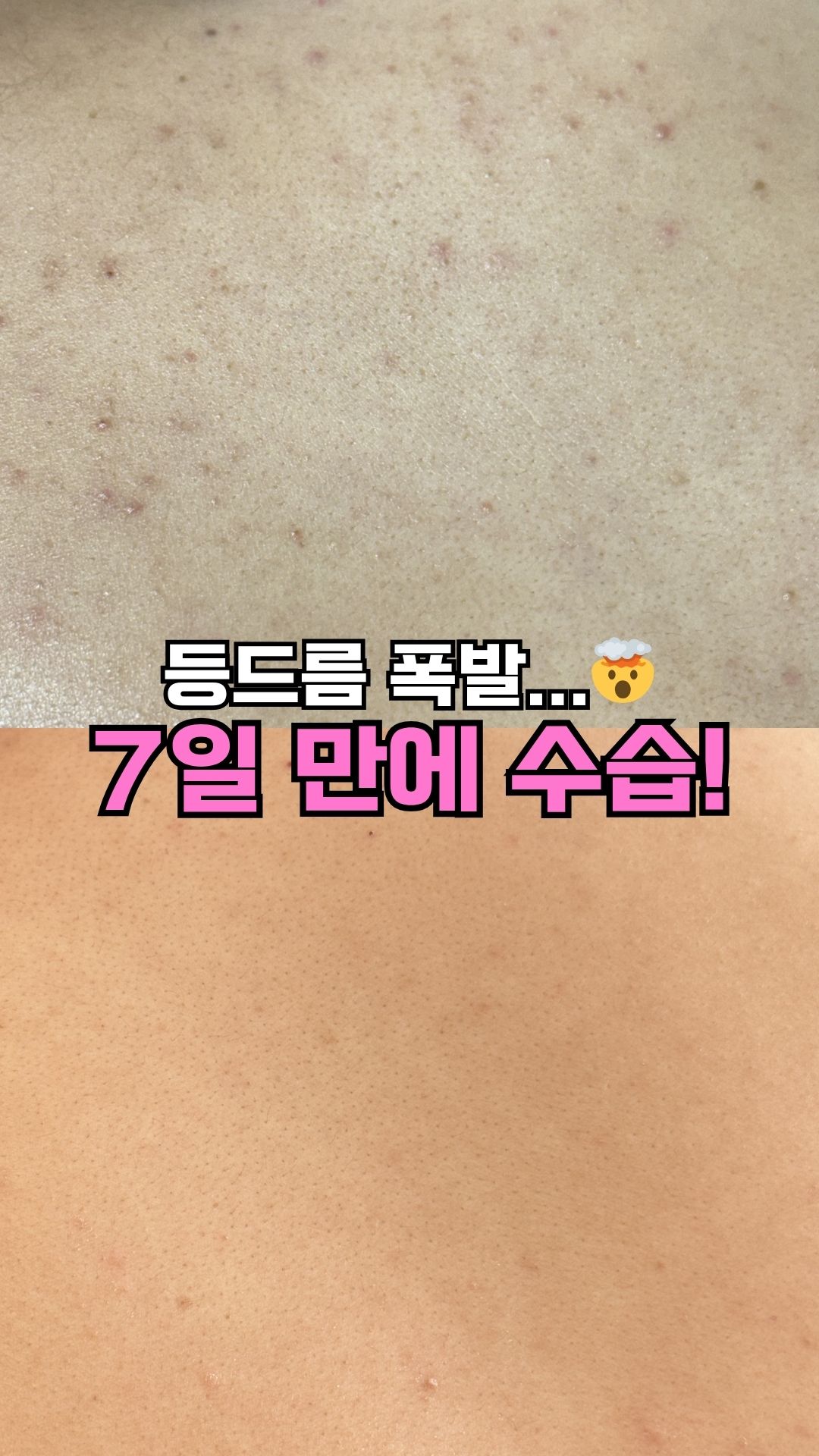 오슬리 인그로운 크림 미스트